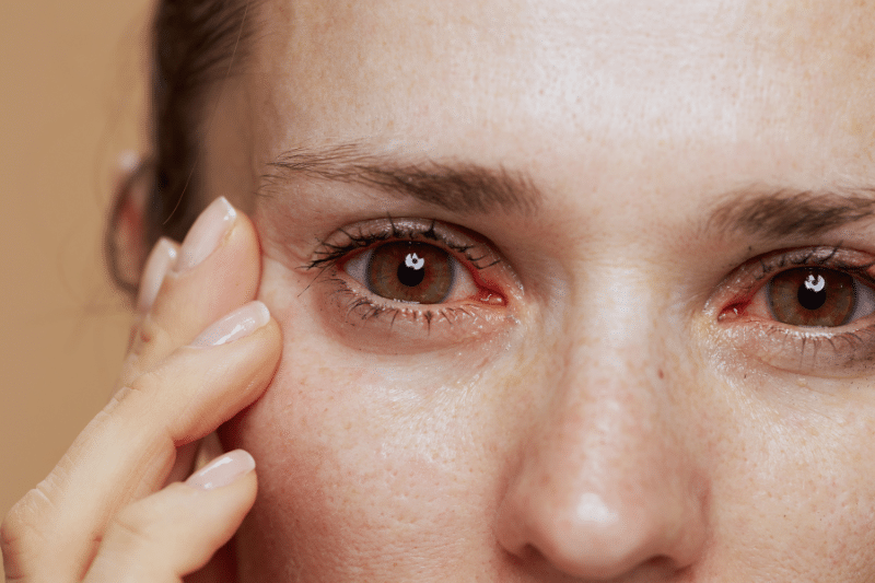 Dry Eyes Treatment Dry Eye Specialist in Georgia