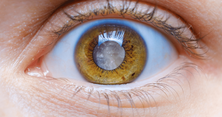 Angle-Closure Glaucoma Specialist in Georgia