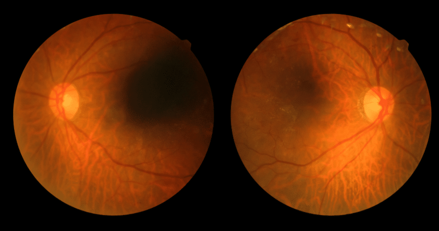 Diabetic Retinopathy Doctor (1) Diabetic Retinopathy Doctor