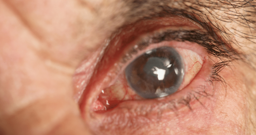 Open-Angle Glaucoma Specialist in Georgia