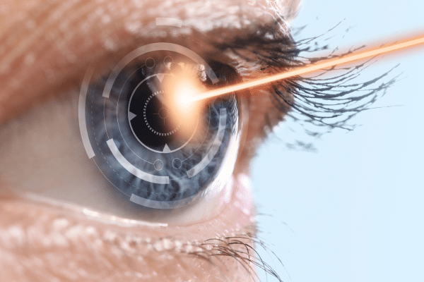 Selective Laser Trabeculoplasty