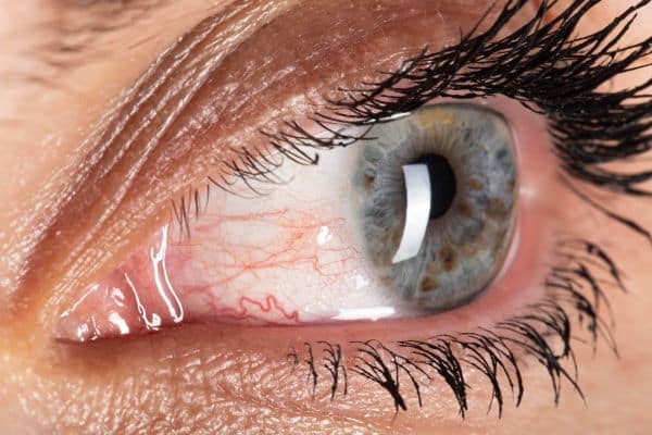 Uveitis treatment